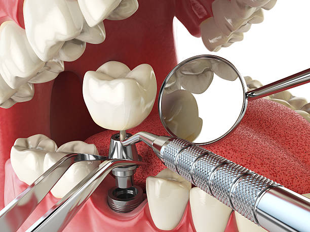 Best Emergency Denture Repair in Garner, IA